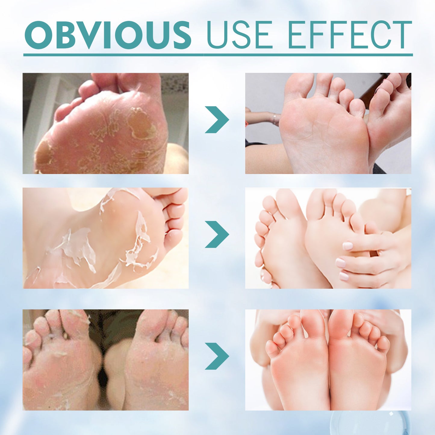 Calluses Relieve Foot Bath Treatment